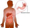 Cancer Images